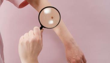 Znamiona pod kontrolą – dlaczego latem warto wykonać dermatoskopię i chronić skórę przed słońcem