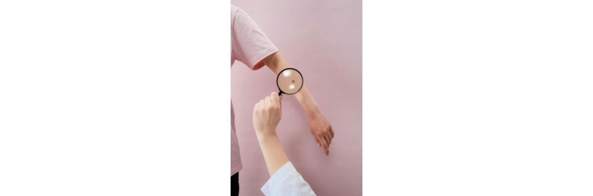 Znamiona pod kontrolą – dlaczego latem warto wykonać dermatoskopię i chronić skórę przed słońcem